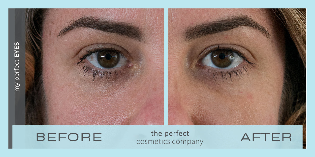 Under eye bags and puffiness before and after using My Perfect Eyes, fine lines and wrinkles, lower eye blepharoplasty alternative