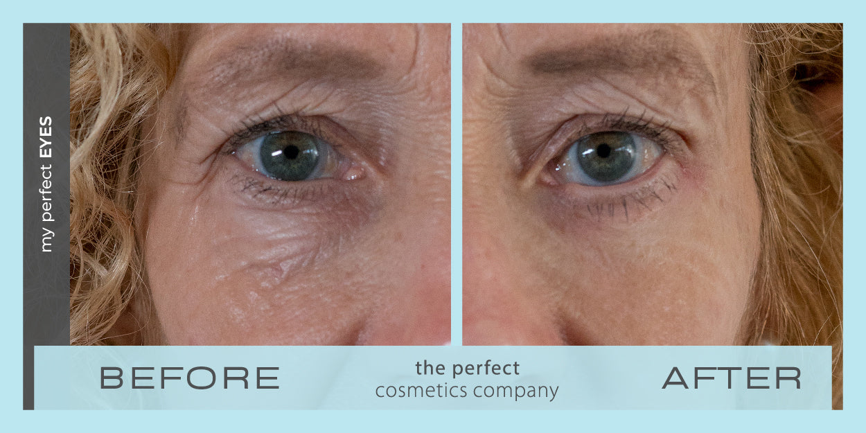Under eye bags and puffiness before and after using My Perfect Eyes, fine lines and wrinkles, lower eye blepharoplasty alternative