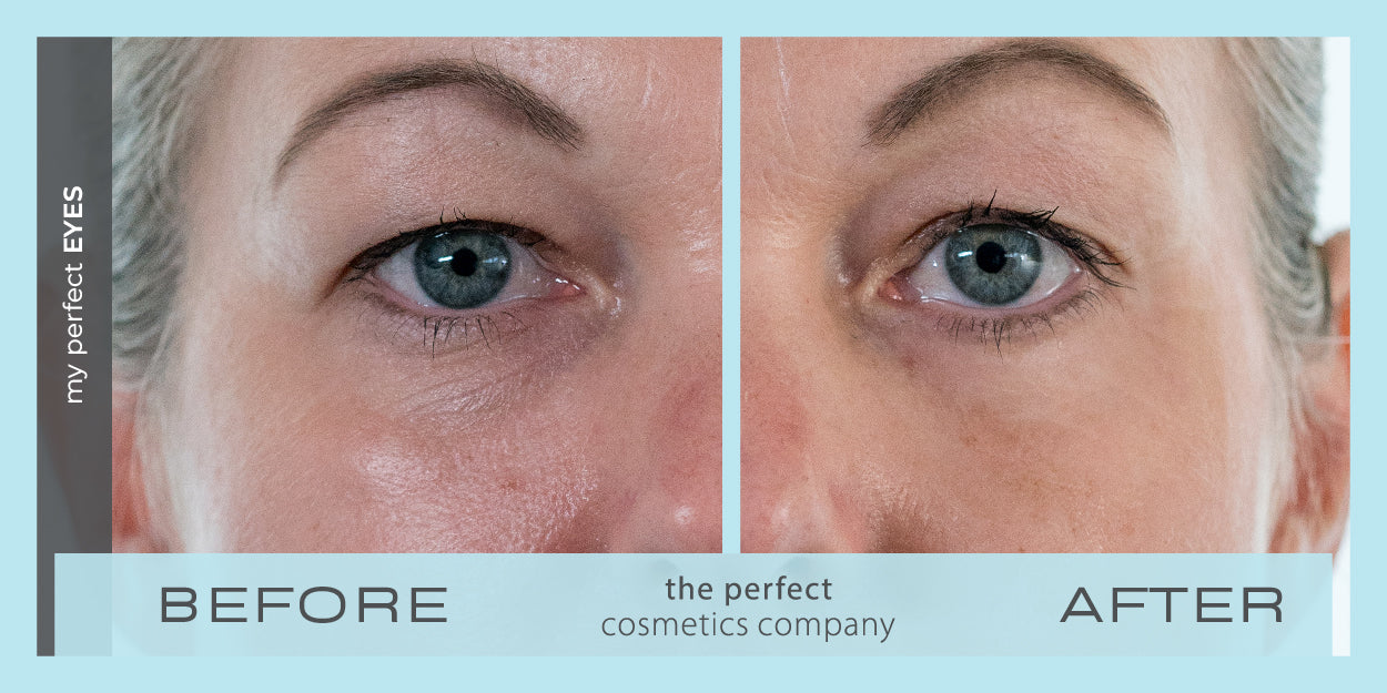 My Perfect Eyes before and after results for under eye puffiness, eye bags, fine lines and wrinkles, lower eye blepharoplasty alternative