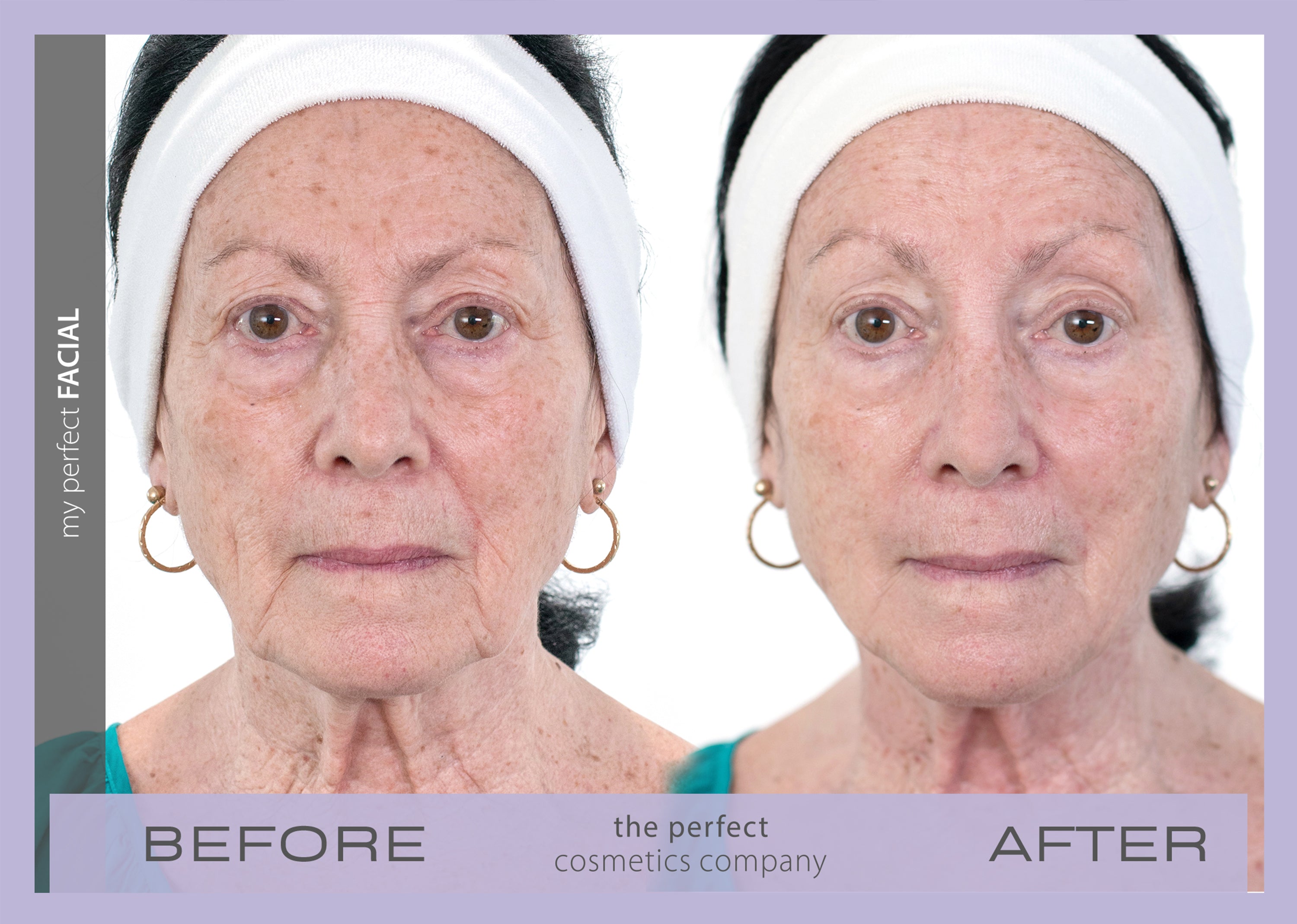 My Perfect Facial results before and after lifting, toning, firming face neck and décolletage for smoother complexion