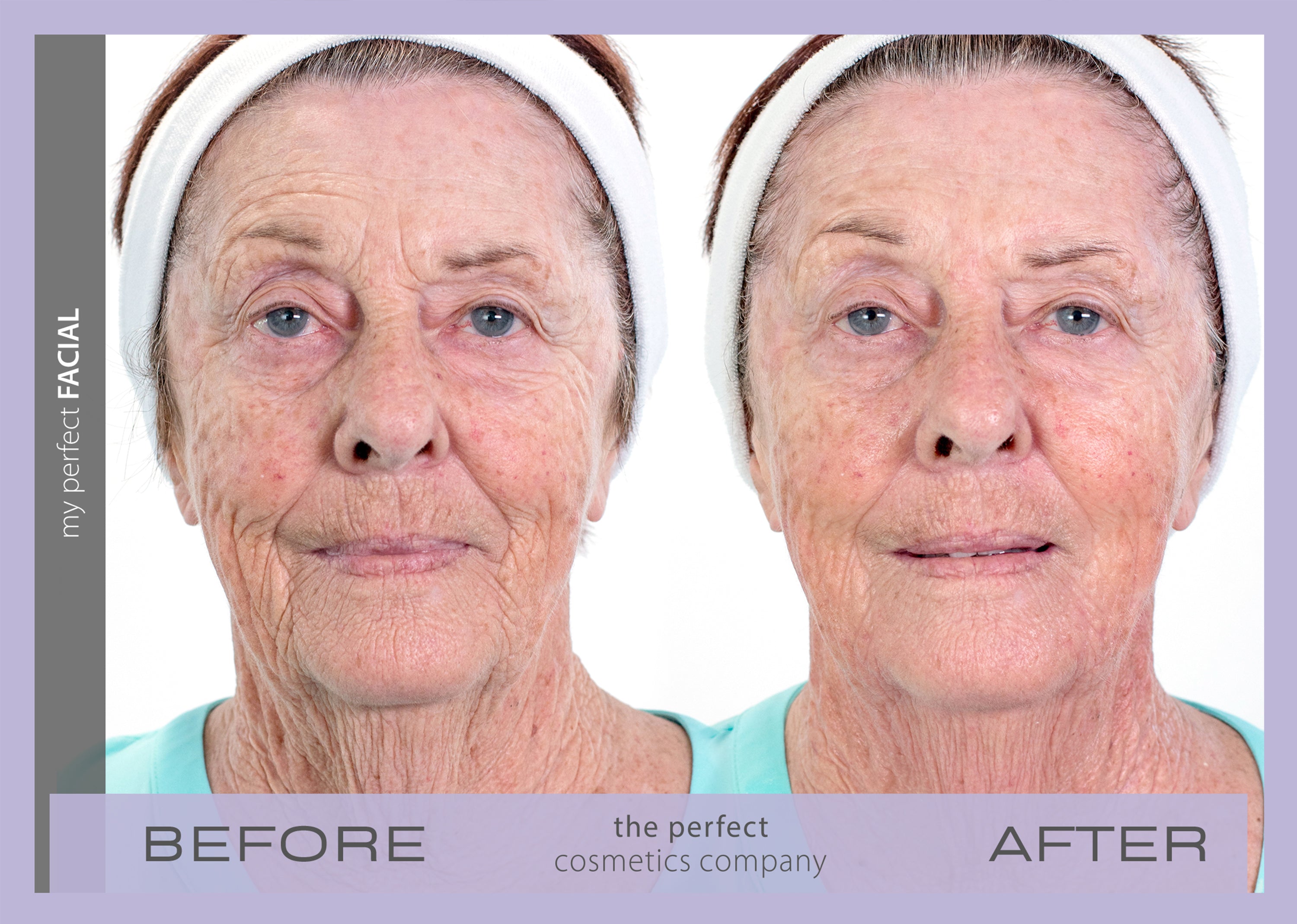 Before and after anti aging facial contouring with My Perfect Facial, smoothing skin texture, softening lines and wrinkles