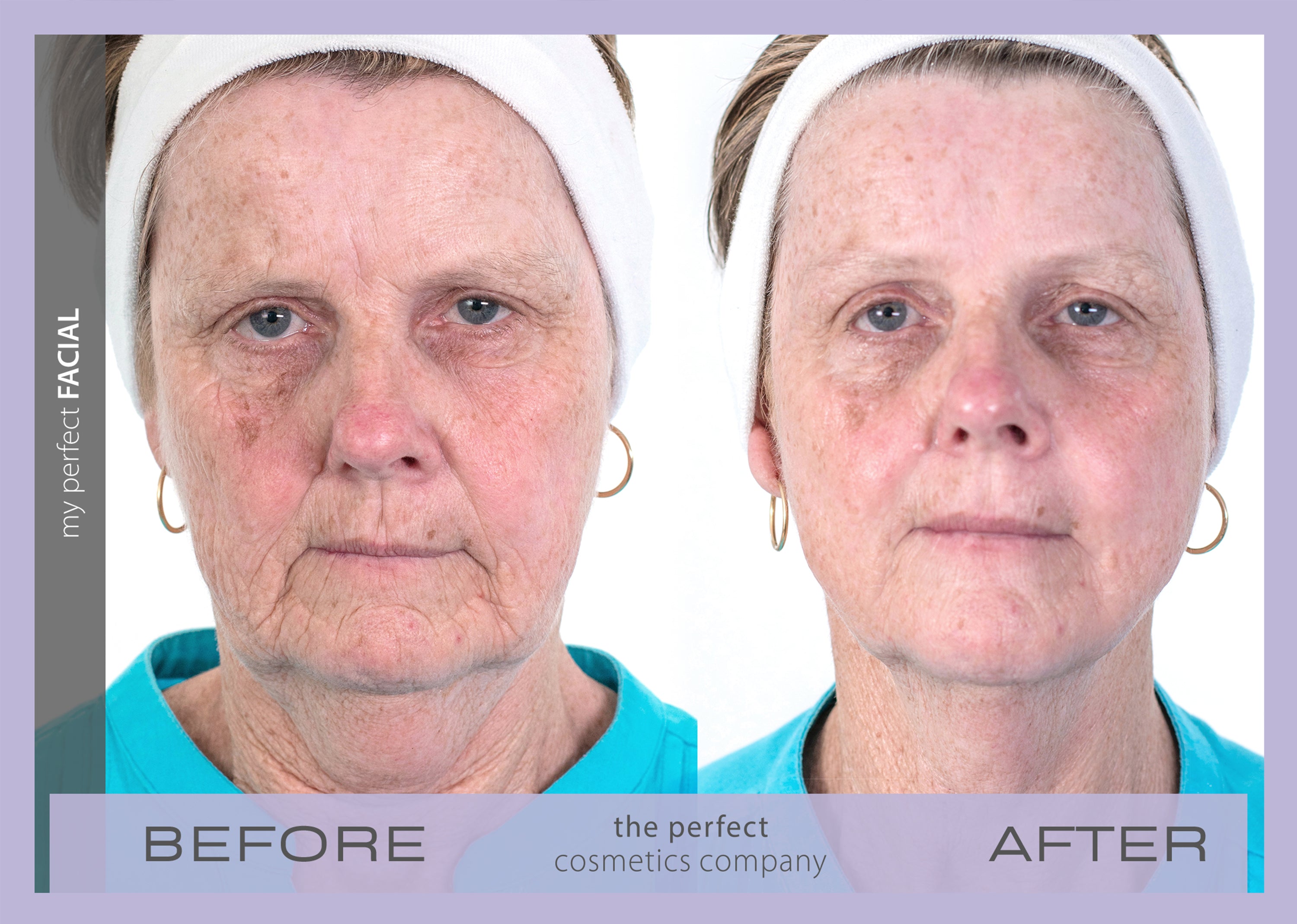 Before and after anti aging facial contouring with My Perfect Facial, smoothing skin texture, softening lines and wrinkles