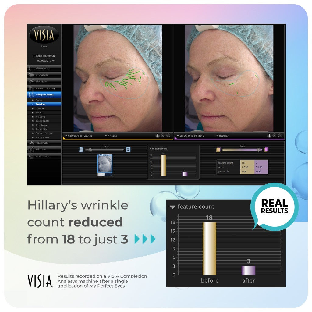 VISIA complexion analysis