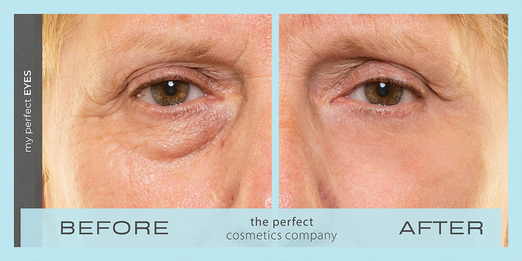 Before and after results for My Perfect Eyes